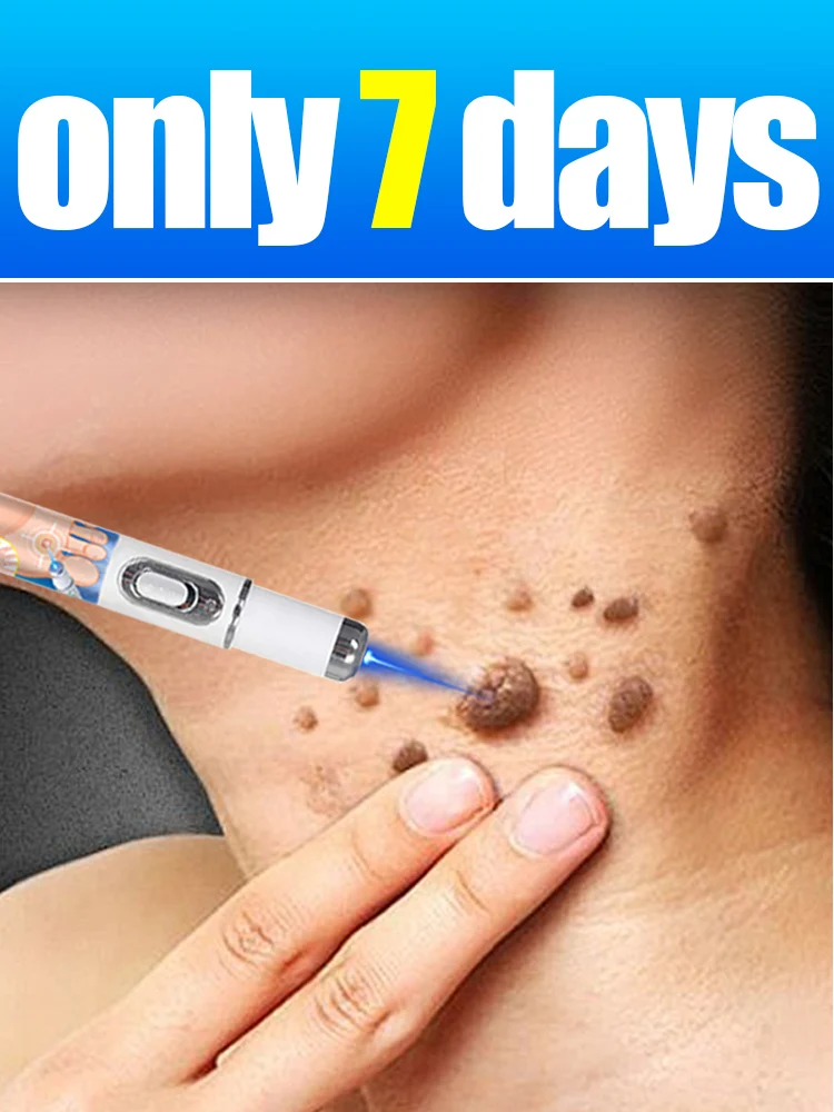 

2025 hot sale blue light pen solve warts, hot sale wart care tools