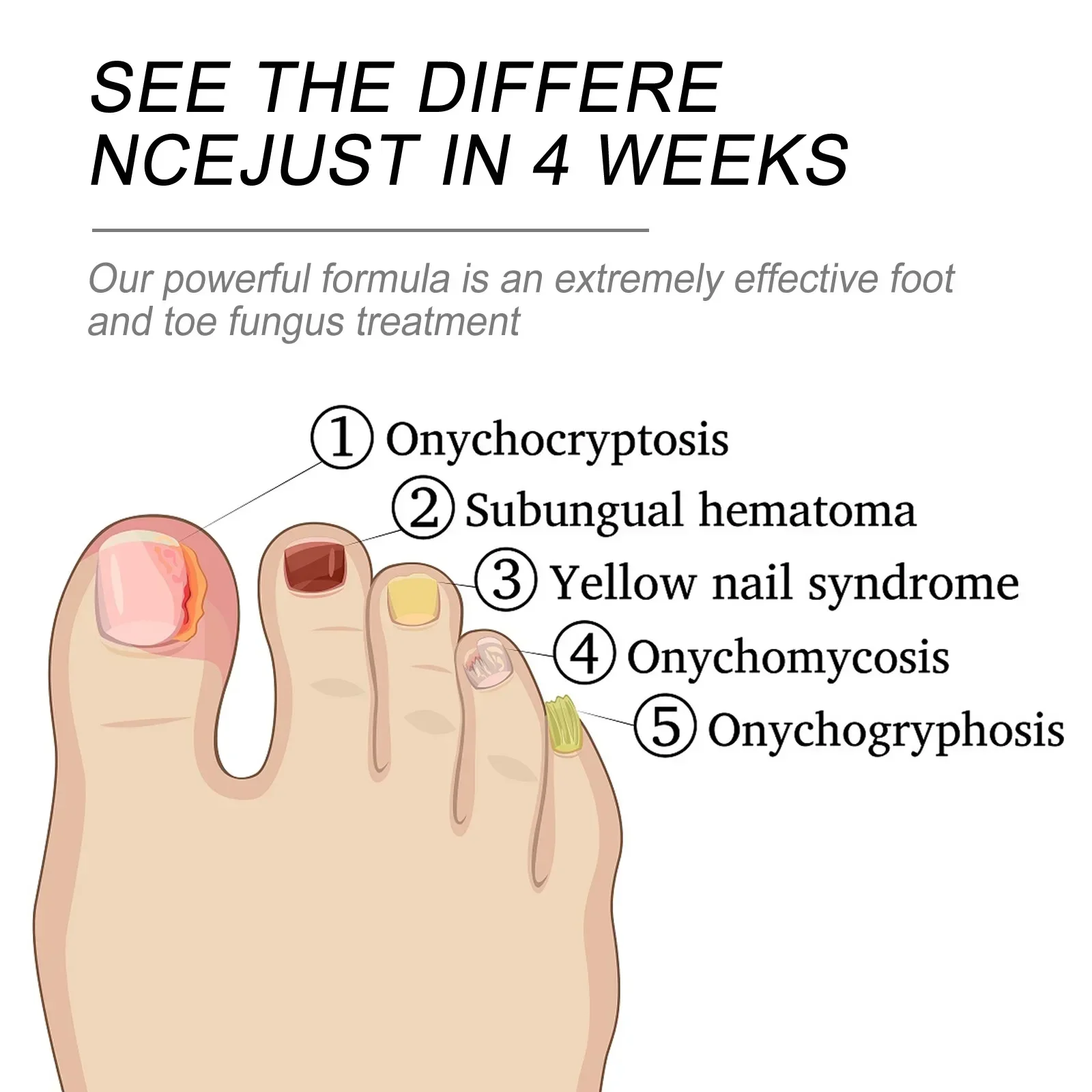 เซรั่มป้องกัน paronychia onychia Onychomycosis ป้องกันการติดเชื้อลดการฆ่าเชื้อคุดคืนความเงางามให้เล็บเท้าเชื้อรา Essential น้ำมัน