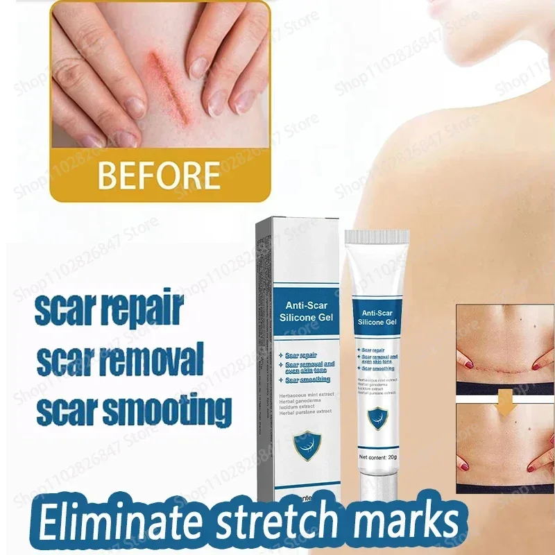 

Eliminate All Red White Old Stretch Marks Cream For Pregnancy Postpartum Skin Care Gel