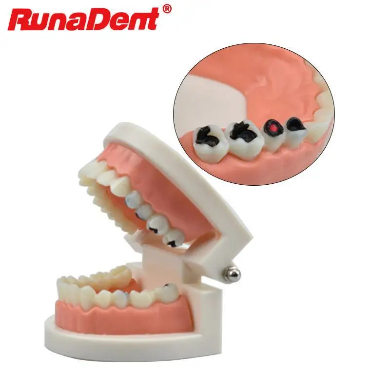 Dentist Student Decay Model Dental Cavities Model Standard Teeth Model Children Kid Teaching Study Demonstration Tool