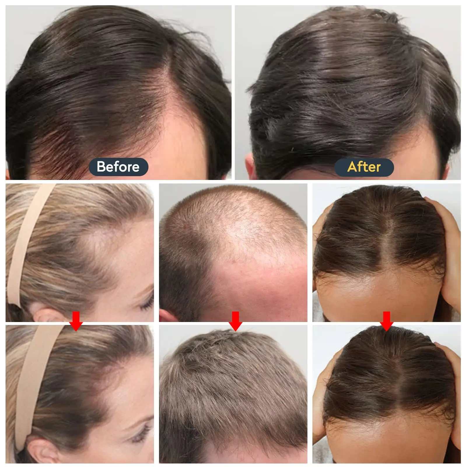 Aceite para el crecimiento rápido del cabello, tratamiento folículo seborreico, Alopecia, línea capilar hacia arriba, posparto, previene la pérdida del cabello, productos para la calvicie