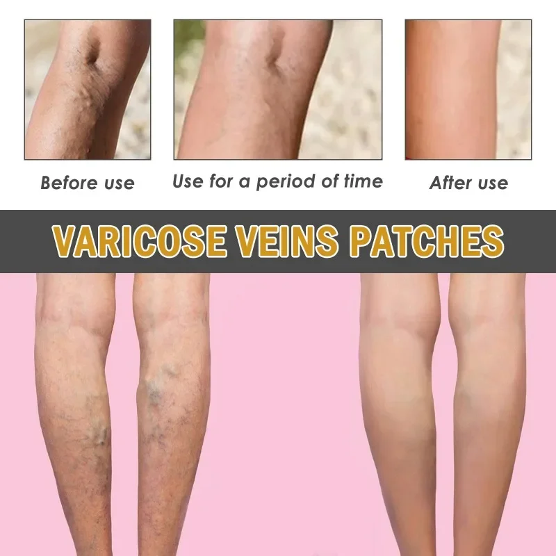 Parche para venas varicosas, parches para aliviar la vasculitis de las piernas, flebitis, tratamiento del dolor de araña, pegatinas para el cuidado