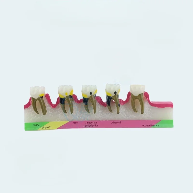 Periodontitis Model Resin Adult Periodontal Evolution Tooth Model Oral Dental Demonstration Teaching