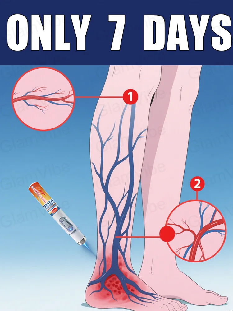 Caneta de luz azul resolve varizes, venda quente de ferramentas para cuidados com as pernas