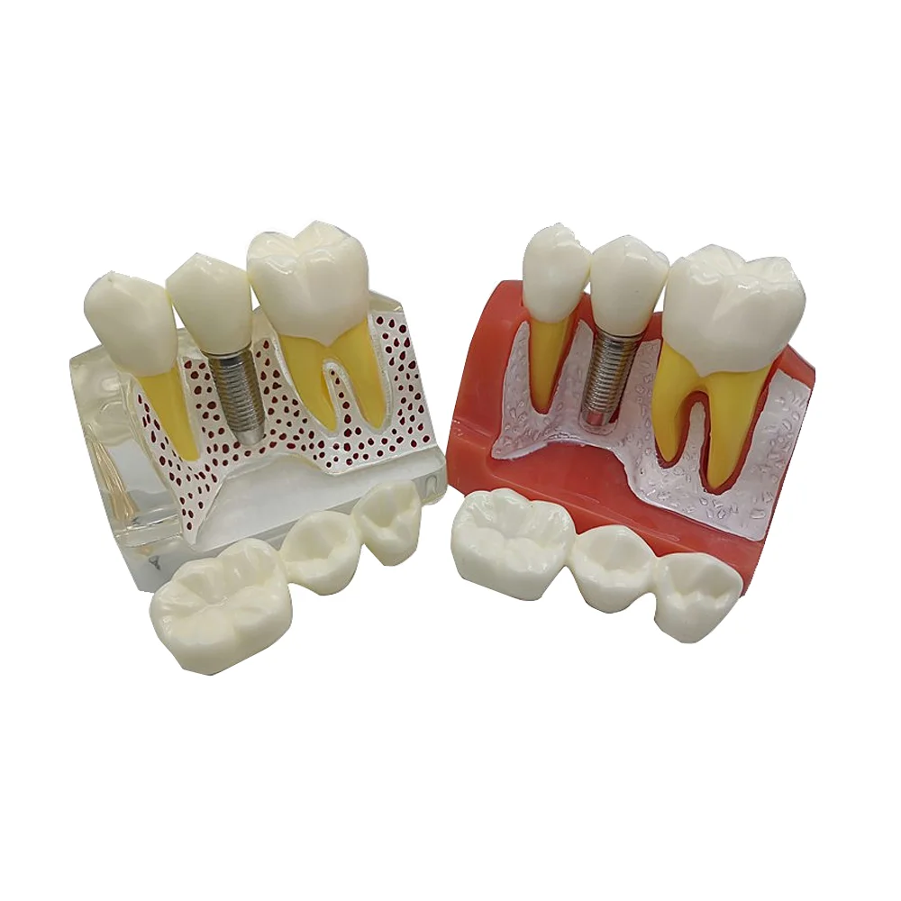 Big Sale Dental 4 Times Teeth Model With Removable Implant Analysis Crown Bridge Dental Implant Teaching Demonstration Model