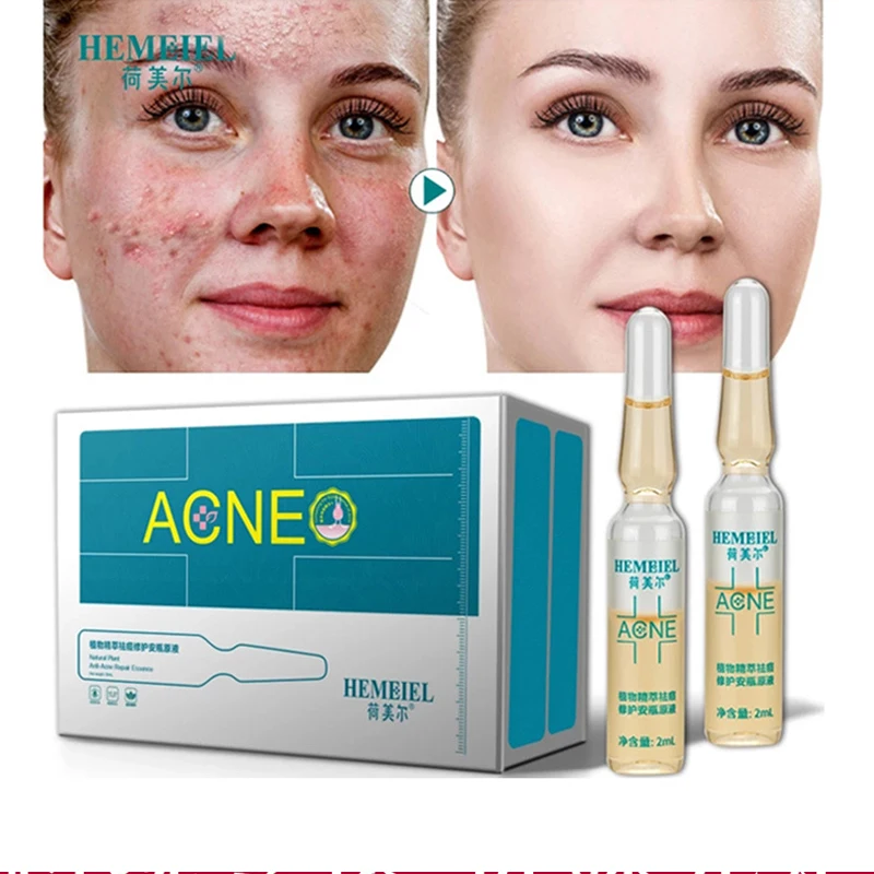 Extrato de planta acne-remoção de reparação ampola solução original diluir marcas acne pits reparação suave rejuvenescimento da pele essência