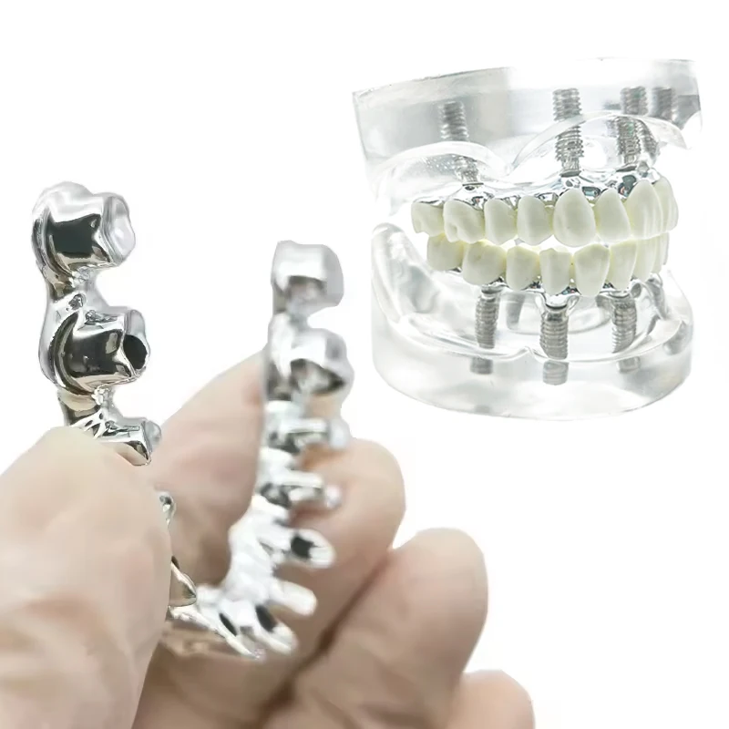 Dental Implant Model 6 Implant Removable Overdenture Restoration Teeth Model Dentist Student Education Typodont Implant Model