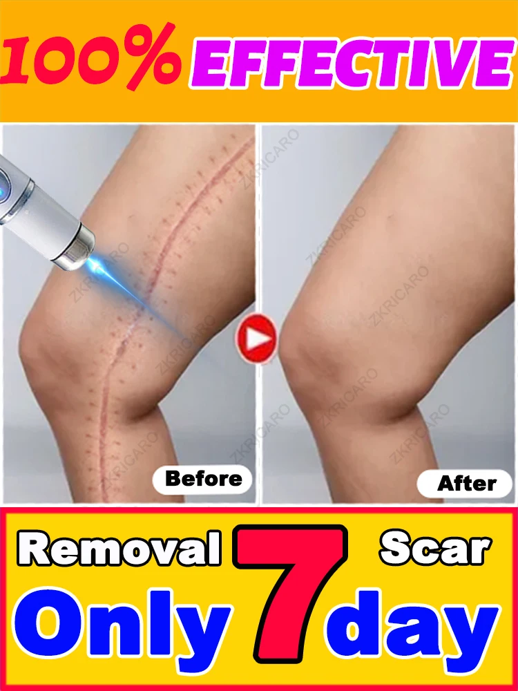 Gebruik een laserpointer om uw littekens verdwijnen te maken