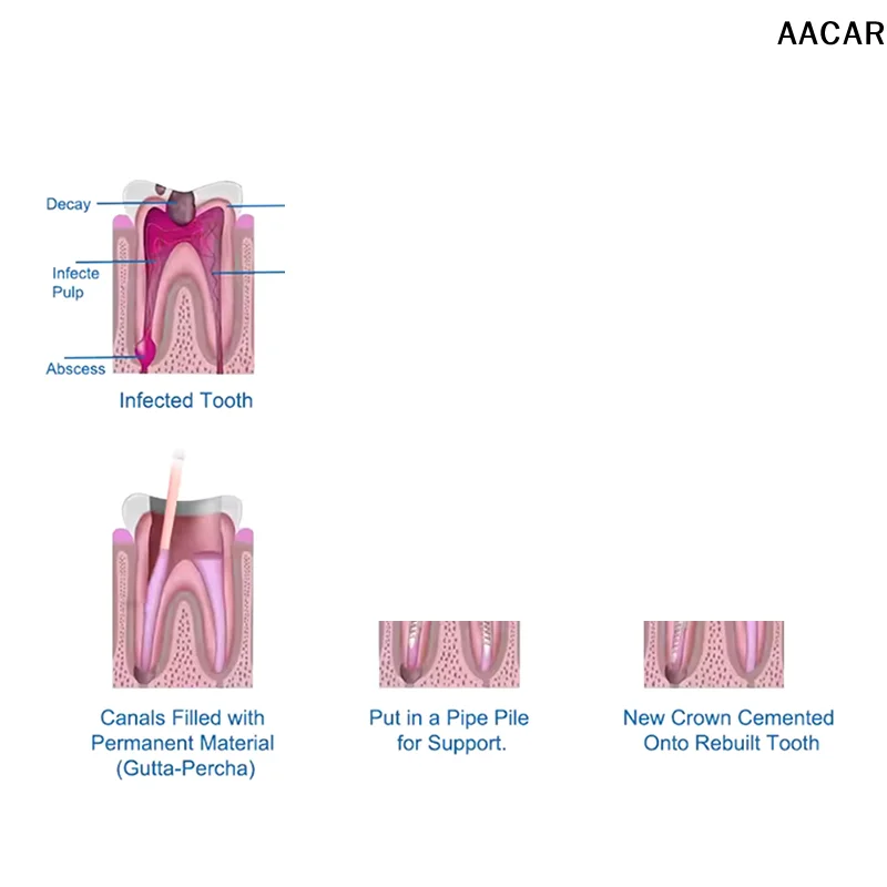 

120 шт., стоматологические винтовые стойки из чистого титана, позолоченные, для обработки имплантатов, конический винтовой столб, S/M/L, фиксированные зубы для ногтей с резьбой