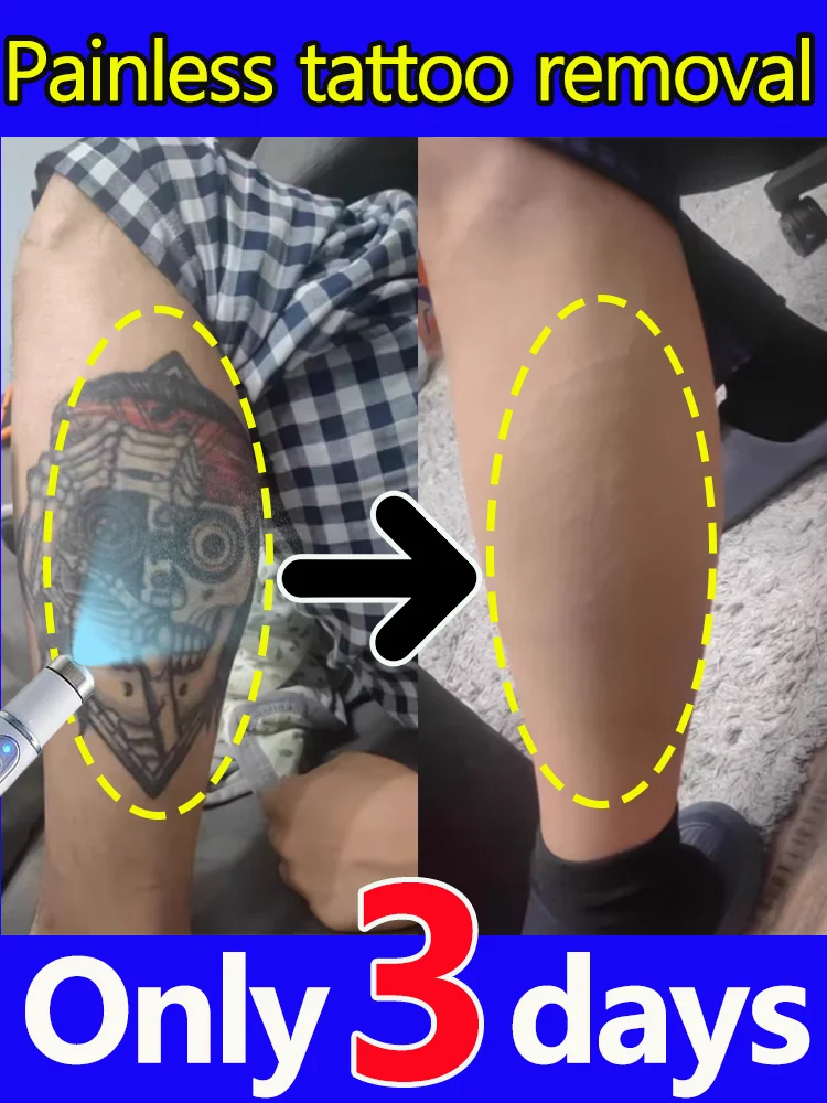 suppression-indolore-des-tatouages-de-differentes-tailles-formes-et-couleurs