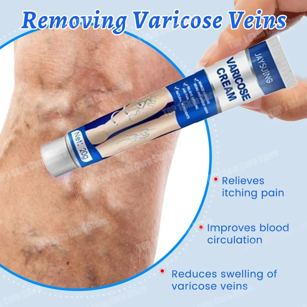 Varicose Vein Treatment Cream 20g Painless Removal Spider Vein Pain Varicosity Effective Varicose Healing Cream