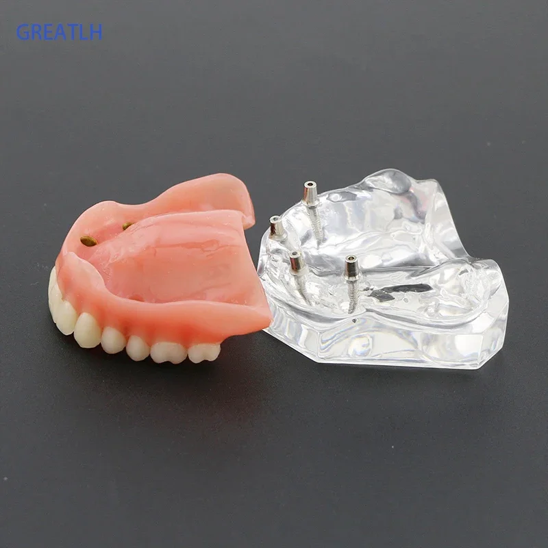 1pcs /pack Dental Upper Overdenture Superior 4 Implants Demo Model 6001 02 Teeth Model