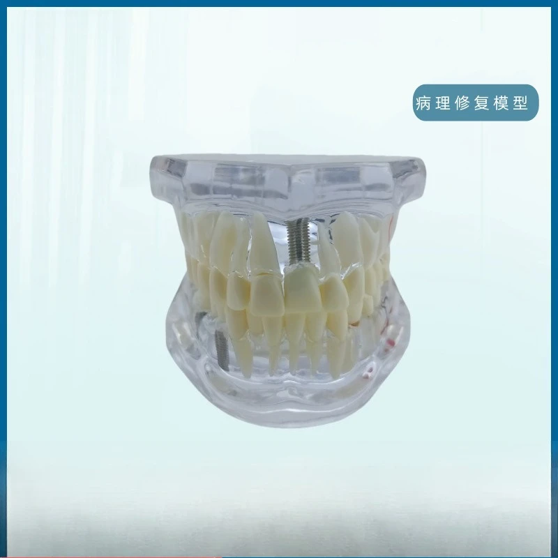 Restoration Model Stomatological Pathology, Doctor-Patient Communication Pathology Restoration Synthesis, Removable Dental Model