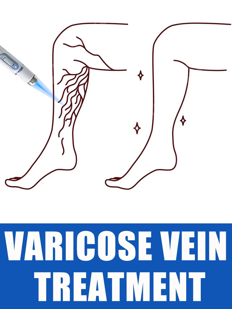 

Laser treatment for varicose veins,ᴍᴇᴅɪᴄᴀʟ grade equipment, painless treatment for spider veins and blood in the legs
