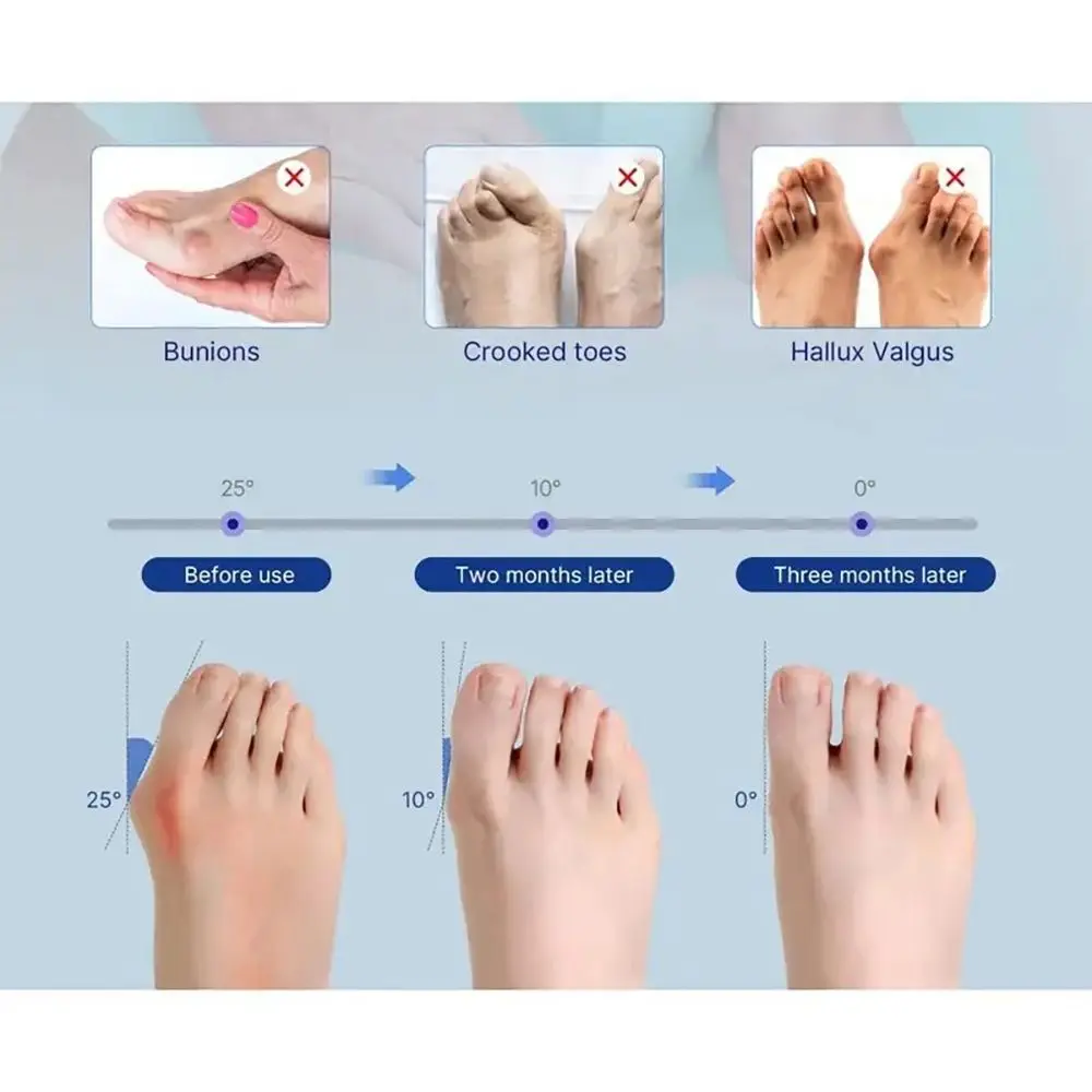 Ergonomic Bunion Corrector Adjustable Strap Reusable Big Toe Straightener Black Bunion Protector Toe Separator Men/Women