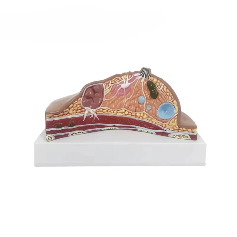 Medical Anatomy Teaching Model of Female Breast Pathology