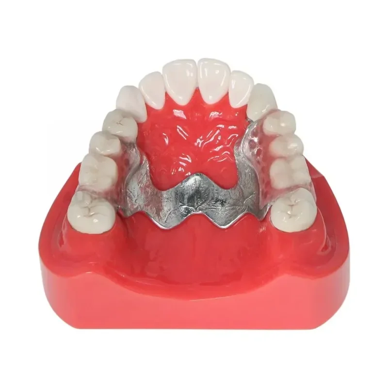 Dental Telescope Crown Model | Removable Prosthesis Demonstration Dental Teaching Aids | Zirconia/Cobalt Chromium Crown