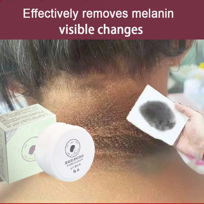 Anti Acanthosis Nigricans Whitening Cream Remove Melanin Armpit Elbow Private Care Products Body Butt Black Sitting Print Remove