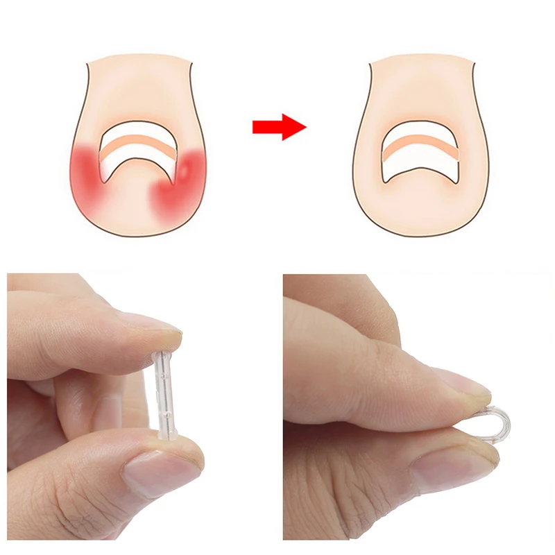 10 pçs 13-20mm adesivos de correção de unhas encravadas corretor de unhas remendos tratamento paroníquia recuperar corretor ferramentas de pedicure