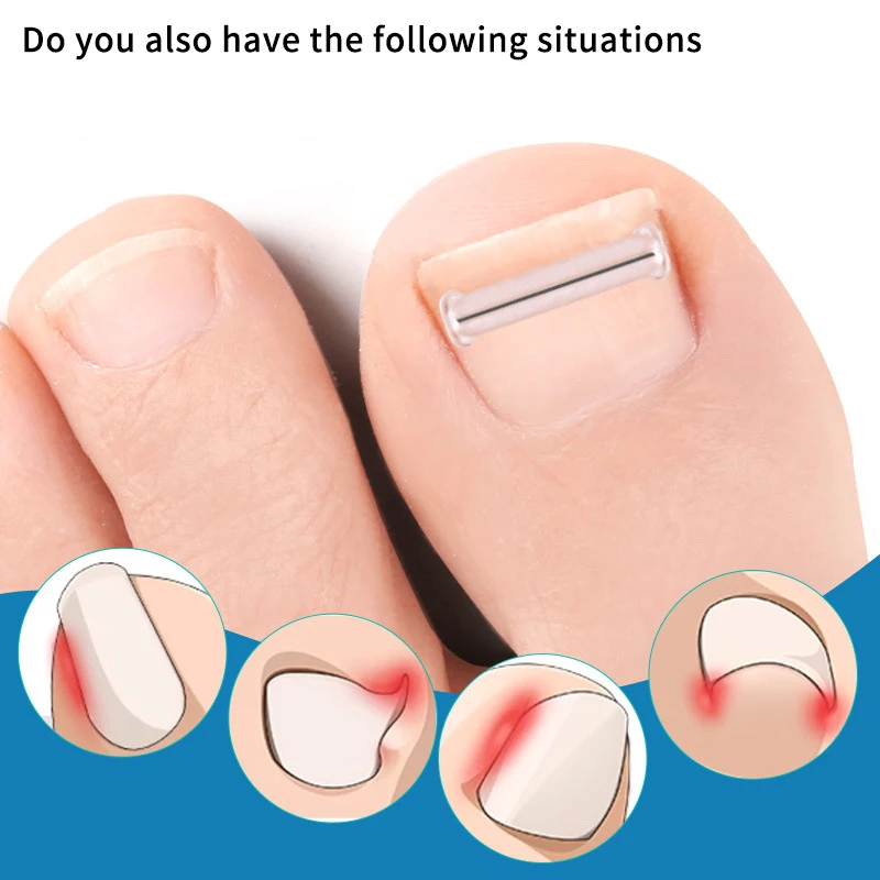 Autocollants correcteurs d'ongles incarnés, 2 pièces, patchs de traitement Paronychia, correcteur de récupération, outils de pédicure, soins des pieds