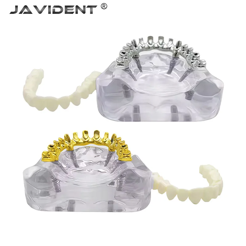 1Pcs Dental Implant Models | Upper Jaw Implant-Supported Dentures | Porcelain-Fused-to-Metal Bridges | Dental Supplies