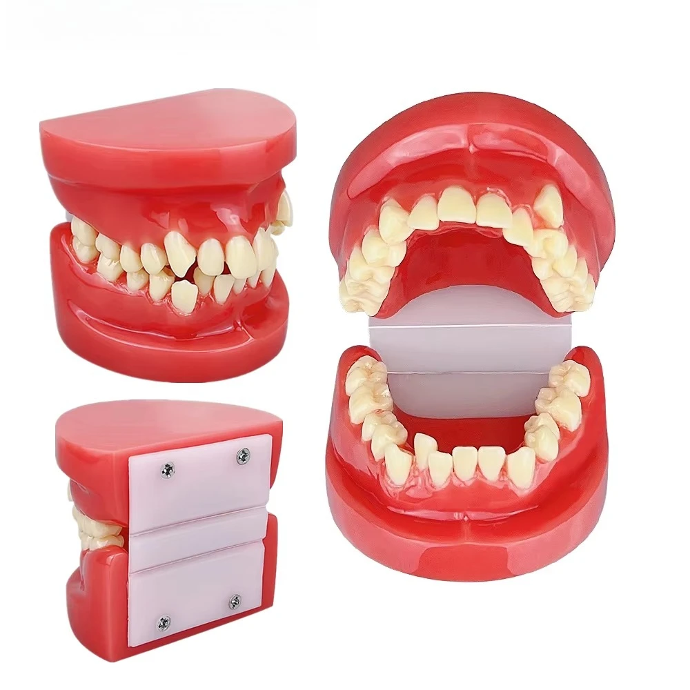 1pcs Dental Model Teeth Malocclusion Model Dentistry Typodont For Teaching Education Demostration Dentist Students Studying Jaws