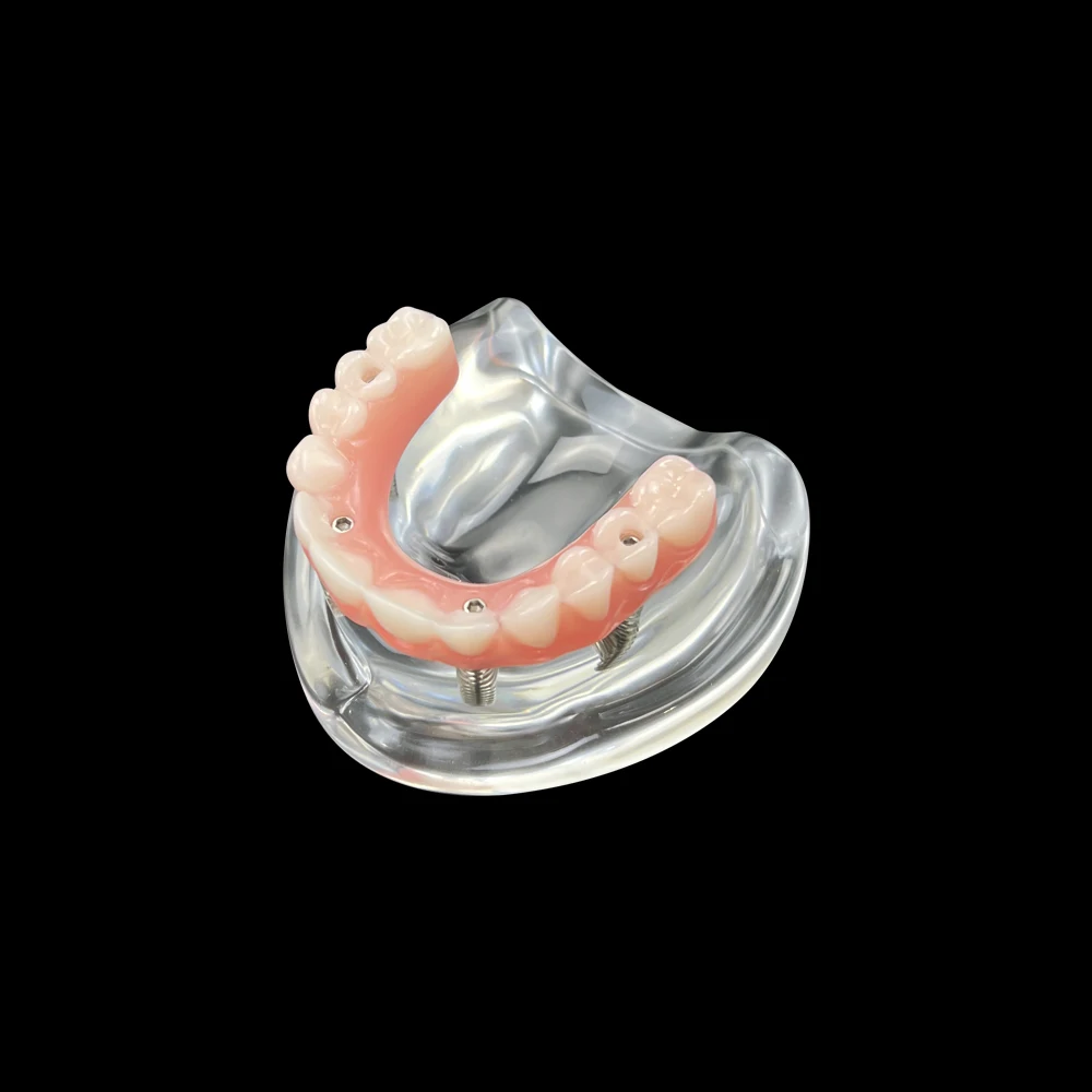 Z implantem Overdenture 4. Wyjmowane śruby. Model górnych zębów. Doskonały model demonstracyjny Typodont. Model do nauki implantów. Model dydaktyczny