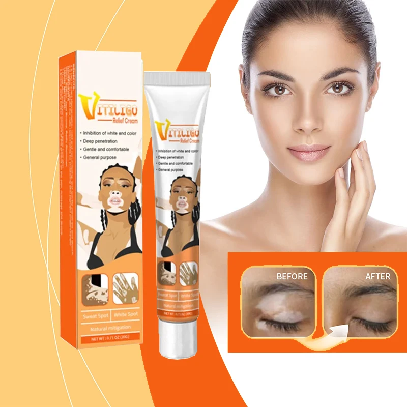 

Body Care Tools Effectively Eliminate Skins Vitiligo Products Remove White Spot Removal Skin Vitiligo