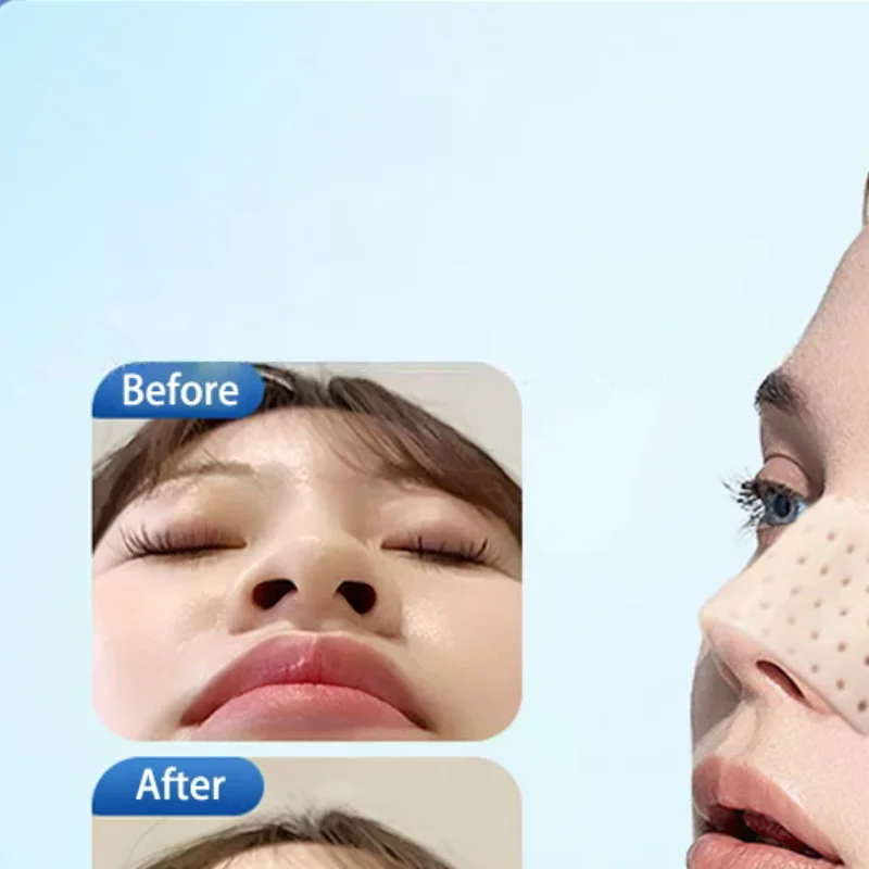 Low Temperature Thermoplastic Nose Splint Nose Job Rhinoplasty Splint Ortho Immobilized Thermoplastic Nose Nasal Fracture Splint