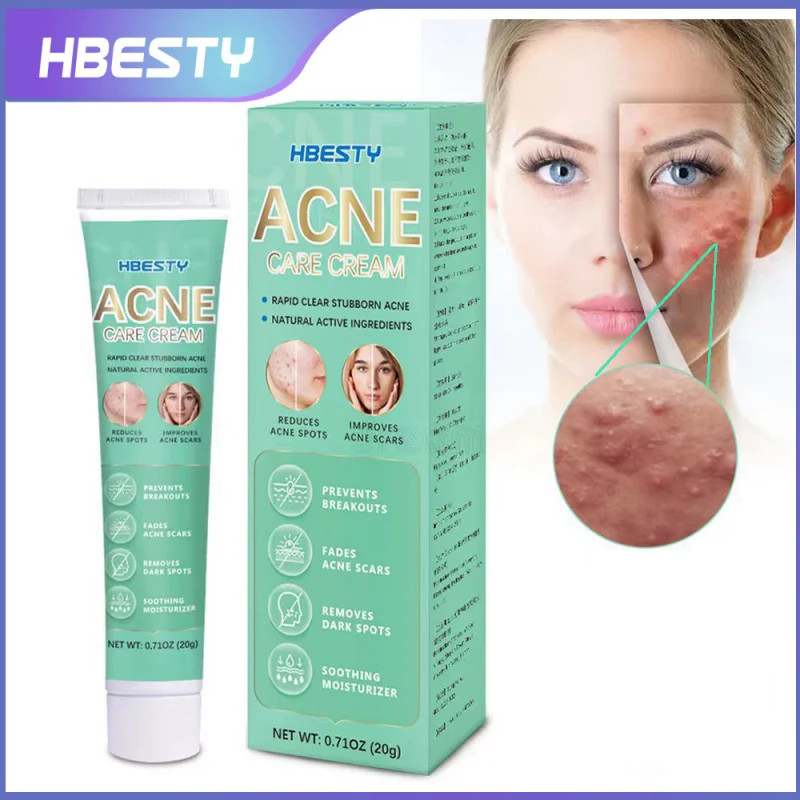 HBESTY Acne Pimple Cream Oil Control Gel Facial Care