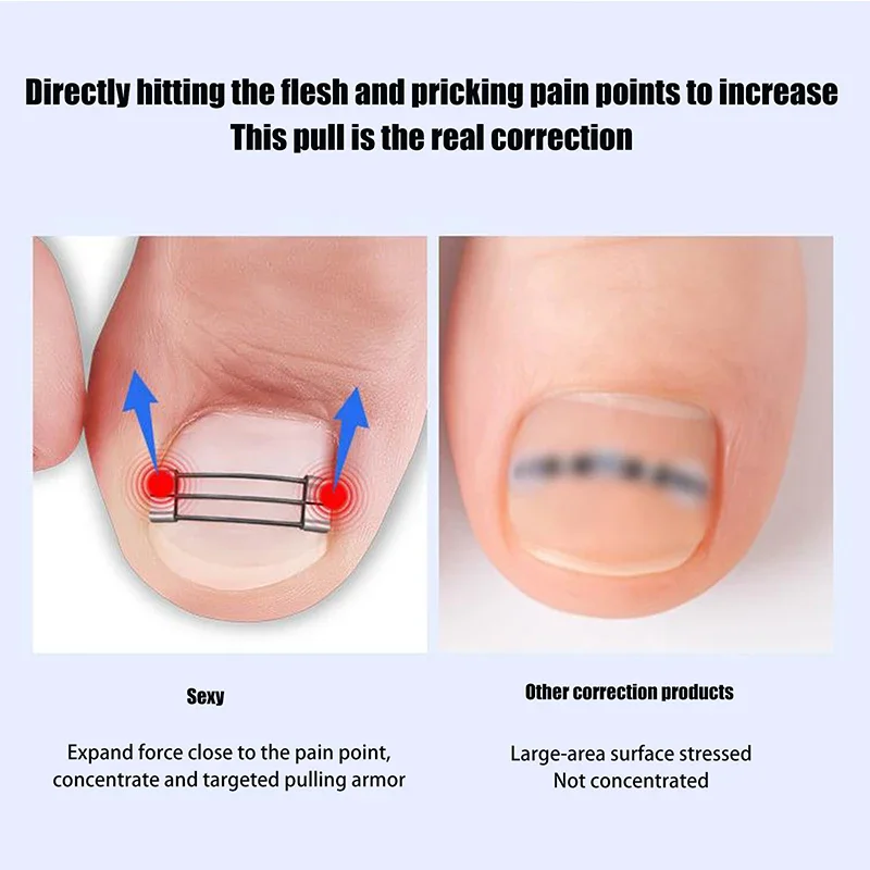 Corrector de uñas encarnadas, herramientas de sujeción, recuperación de pedicura, tratamiento de uñas encarnadas profesional, alisado de uñas encarnadas