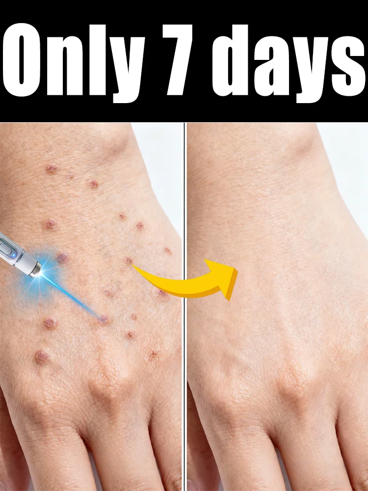 Hᴏᴛ sᴇʟʟɪɴɢ ʙʟᴜᴇ ʟɪɢʜᴛ ᴘᴇɴ ᴛᴏ sᴏʟᴠᴇ ʙᴏᴅʏ ᴡᴀʀᴛs, ᴡᴀʀᴛ ᴄᴀʀᴇ ᴛᴏᴏʟs