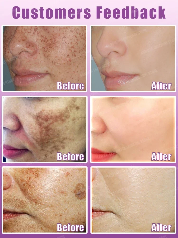 Dark spot Remover For Face ProductsFreckle Melasma Sun Age Spots Deep Removel cream