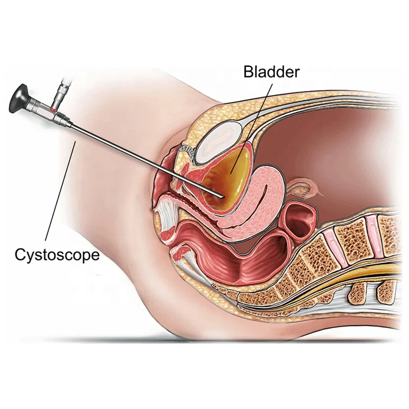 Customizable 0, 30 degree 4mm, 2.7mm rigid endoscope for pediatrics, urology, surgery