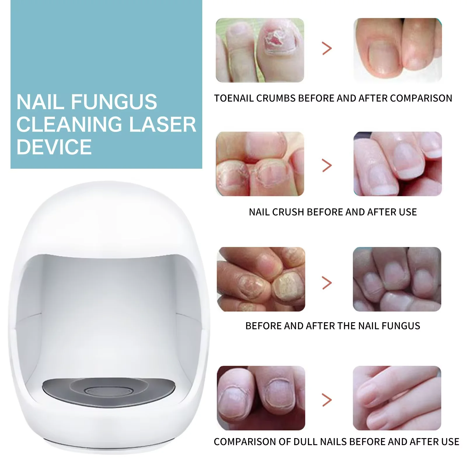 Nail Fungus Laser Therapy Device Mini Painless Anti Onychomycosis Infection Grey Nail Thicken Yellow Embed Brightening Repairing