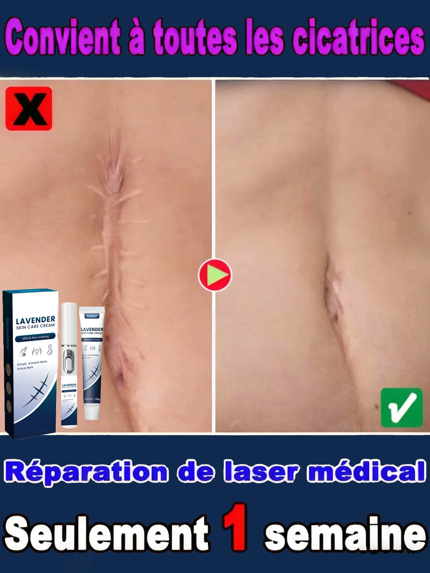 

Pregnancy Stretch Mark Eraser: Professional-Grade Laser Pen for Home Use