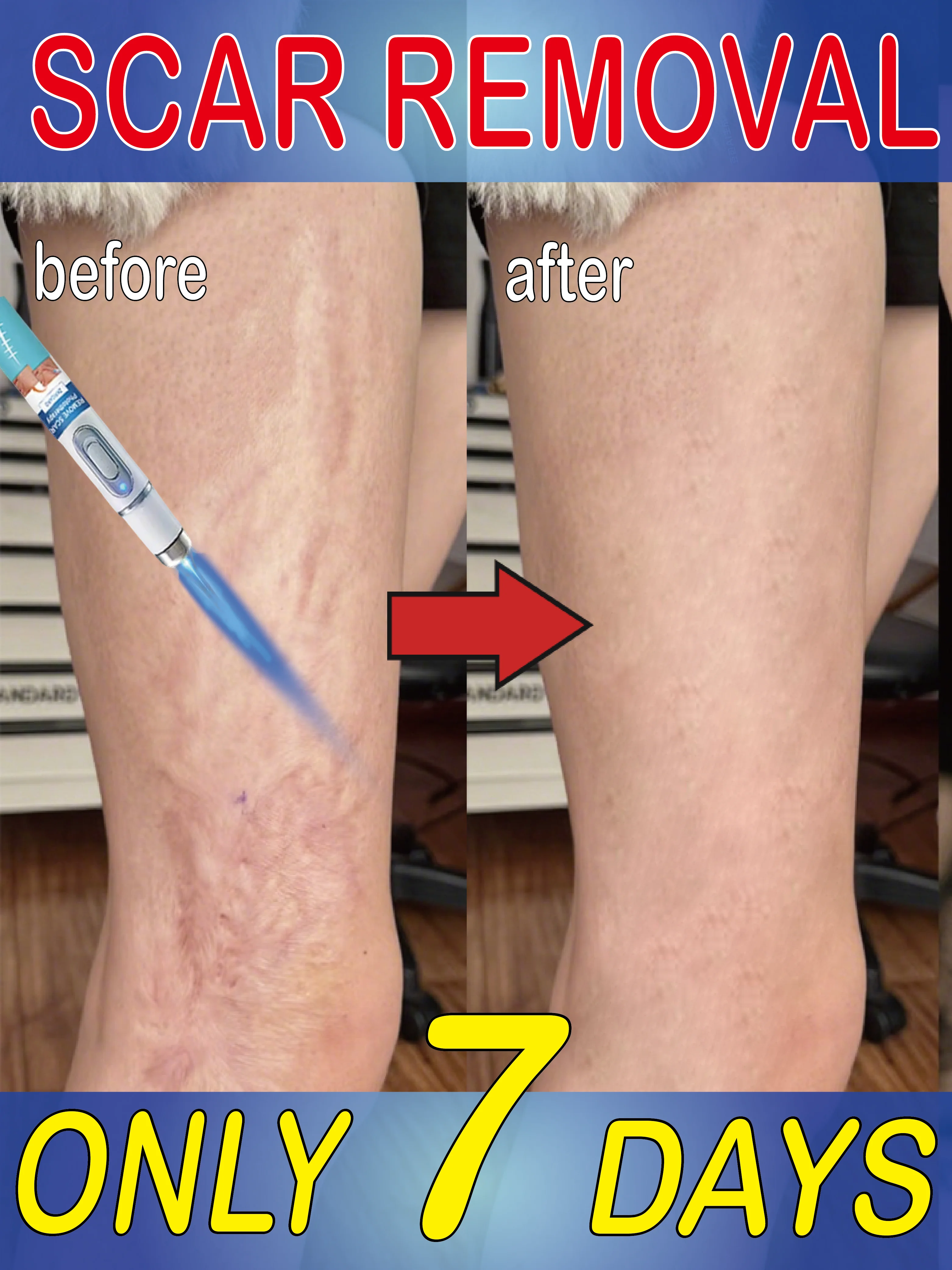 

ᔆᶜᵃʳ ᴿᵉᵖᵃⁱʳ ᔆᶜᵃʳ ᴿᵉᵐᵒᵛᵃˡ ᶜʳᵉᵃᵐ ᔆᶜᵃʳ ᶠʳᵉᵉ ᔆᶜᵃʳ ᴿᵉᵐᵒᵛᵃˡ,First place in scar removal