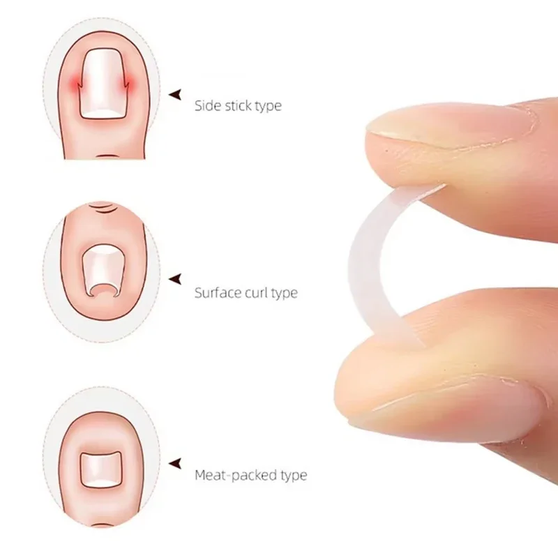 Traitement des ongles incarnés, outil de Correction des ongles incarnés, Patch élastique autocollant, Clip de redressage, attelle, outils de pédicure, 10 pièces