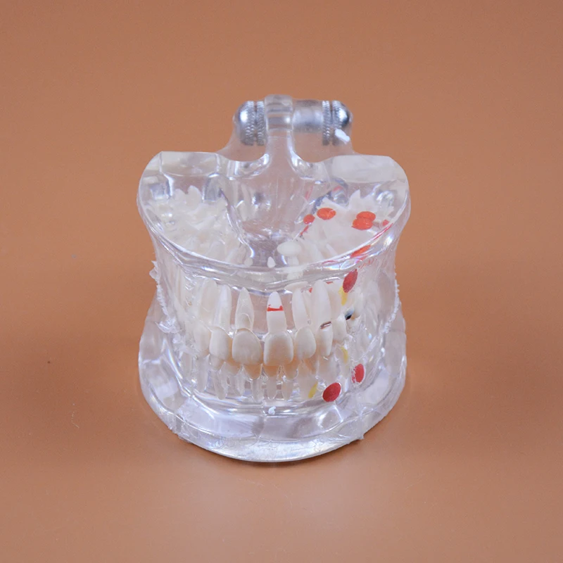 HST-C3 Dental Pathology Model Dentistry Oral Care Teaching Model Half Side Can Be Removable