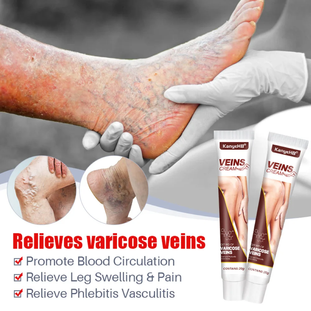 Varicose Vein Treatments Cream Effective Relieve Legs Dilated Vasculitis Phlebitis Spider Legs Natural Formula Ointment