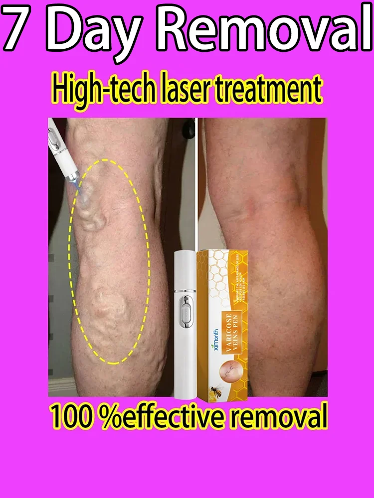 

Varicose Veins Laser Relieve Pain And Improve Circulation