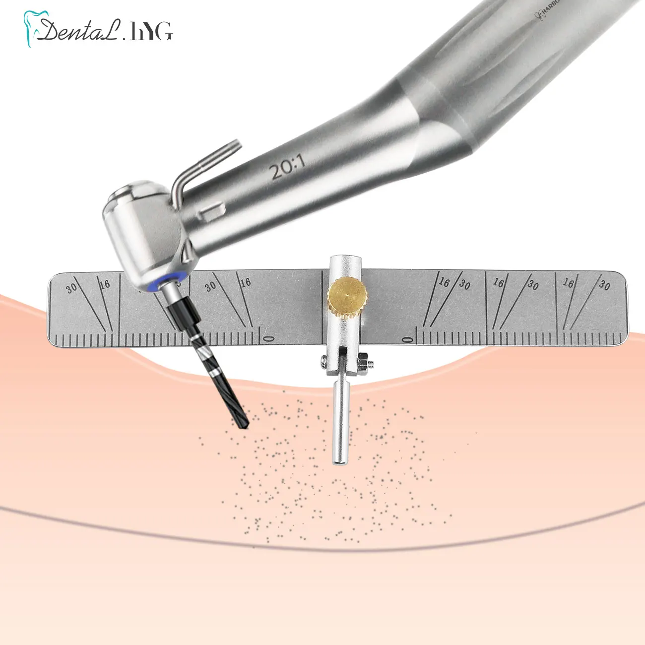 치과 임플란트 위치 지정 가이드 수술 심기 위치 지정 로케이터 각도 눈금자 게이지 Autoclavable