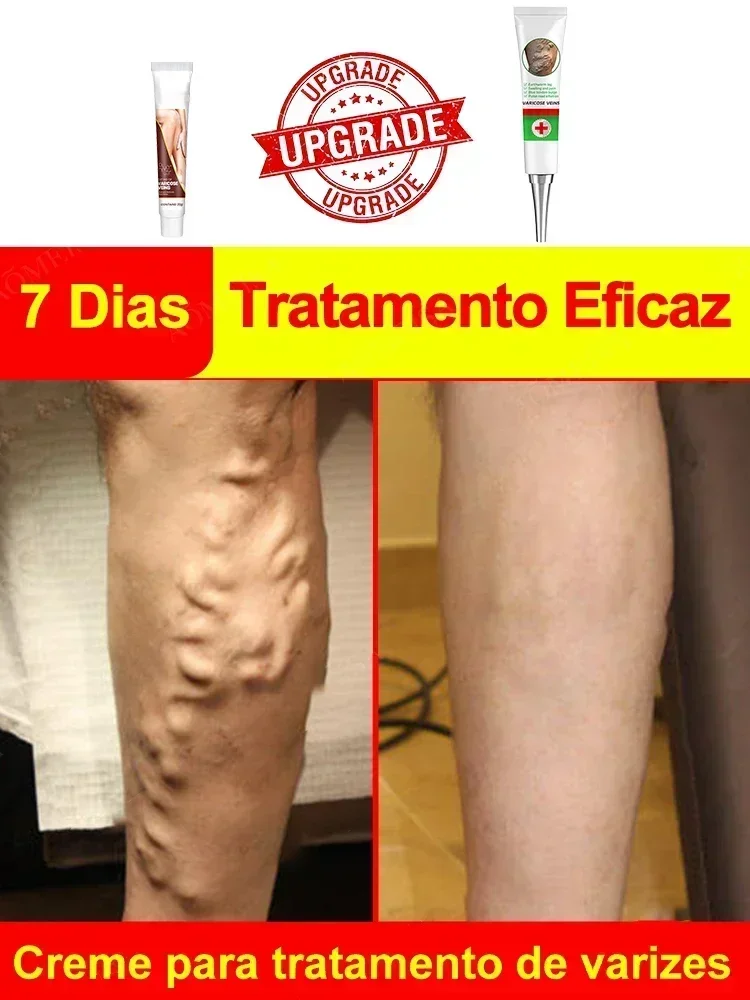 Effective varicose vein soothing cream. Vasculitis, phlebitis, spider leg soothing cream