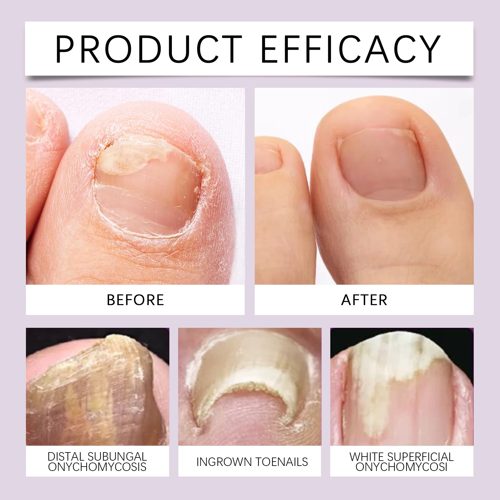 Solución para el cuidado de uñas gris con veneno de abeja, limpieza de uñas gris para manos y pies, reparación nutricional, espesamiento de uñas podridas y brillantes