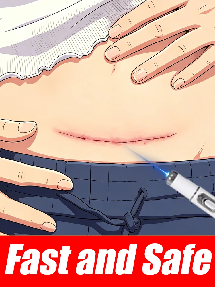High-Efficiency Blue Light Scar Pen Deep Repair and Smooth Skin in Just Weeks