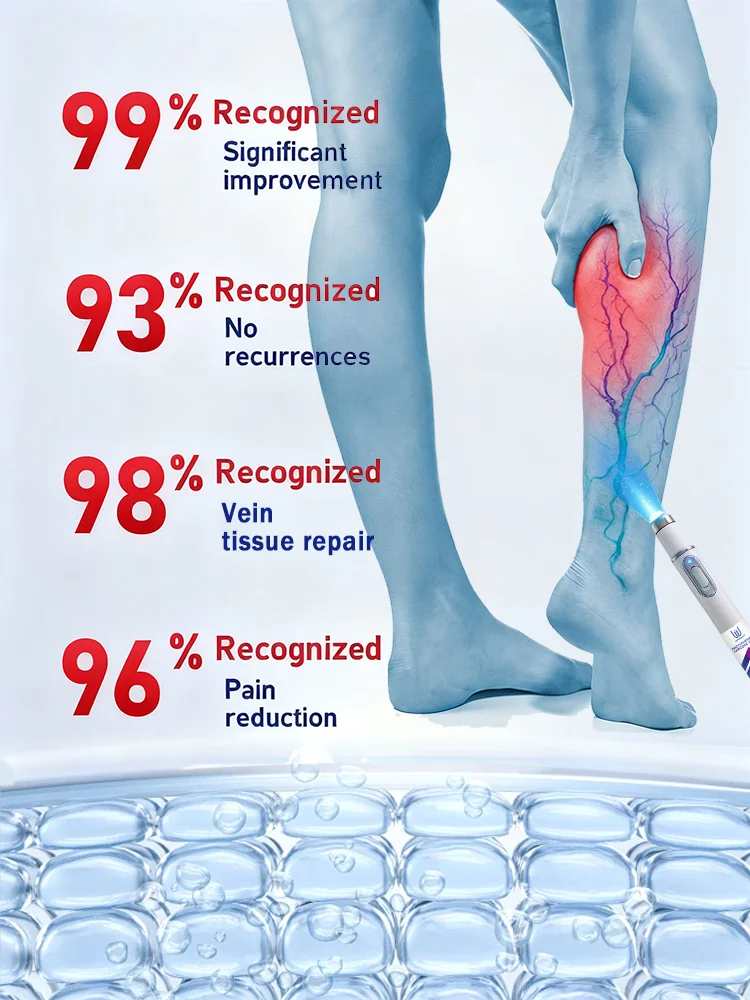 Tʜɪʀᴅ ɢᴇɴᴇʀᴀᴛɪᴏɴ ᴠᴀʀɪᴄᴏsᴇ ᴠᴇɪɴ ʟᴀsᴇʀ ᴇʟɪᴍɪɴᴀᴛᴇs ᴠᴀsᴄᴜʟɪᴛɪs ᴀɴᴅ ᴘʜʟᴇʙɪᴛɪs, ʀᴇʟɪᴇᴠᴇs sᴘɪᴅᴇʀ ʟᴇɢ ᴘᴀɪɴ, ʟᴀsᴇʀ ᴘᴏɪɴᴛᴇʀ ᴛʜᴇʀᴀᴘʏ