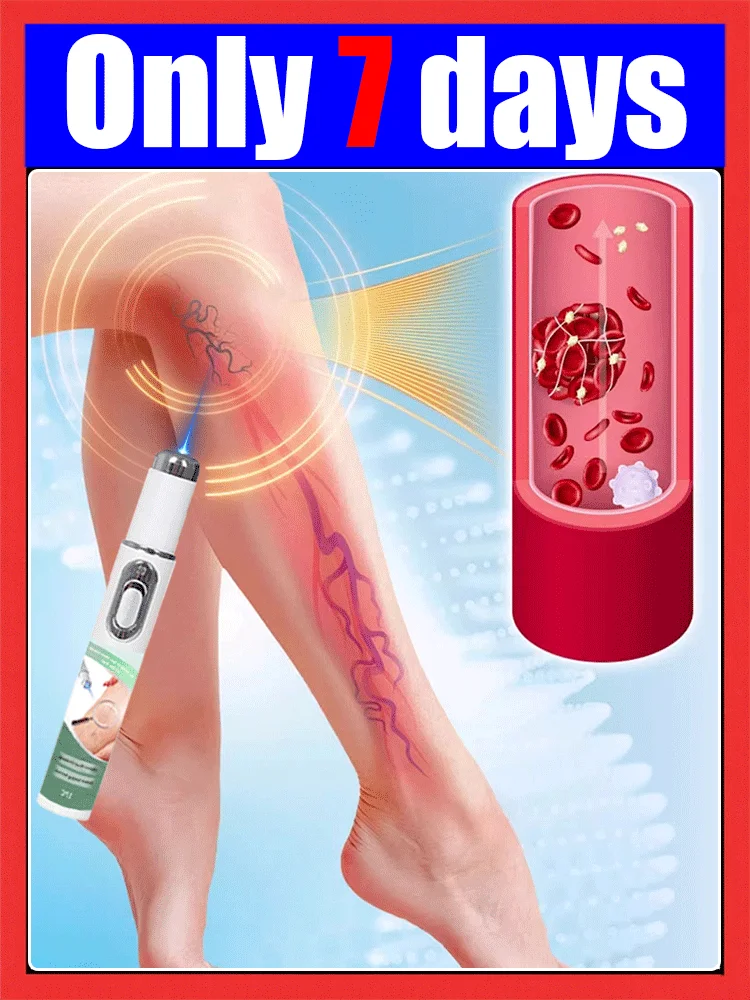 Le nouveau Laser pour varices élimine la vascularite et la phlébite، Soulage la douleur des jambes d'araignee، therapie par