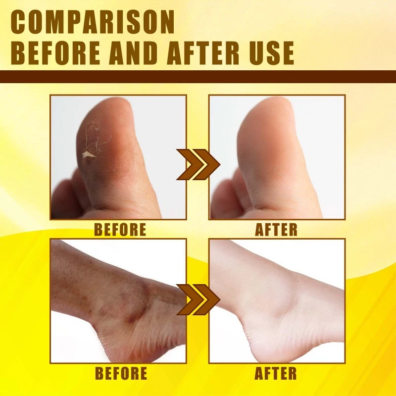 Exfoliating Yellow Skin Oil Moisturizes Removal Chicken Skin Delicates Skin Repair Brightens Yellow Improve Dry Body Care Oil