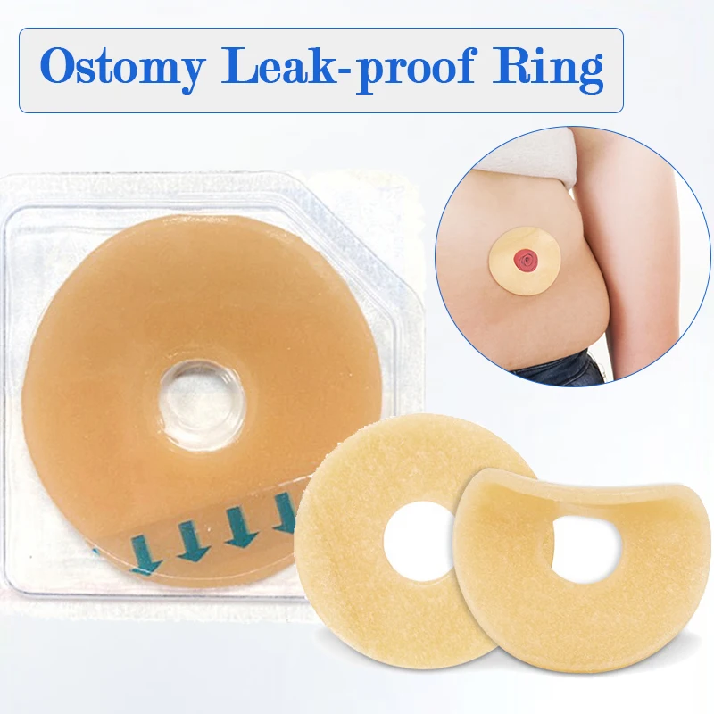 1 buah cincin pasta Ostomy, baseplate Stoma perawatan anti bocor cincin untuk tas Ostomy pembentuk regang untuk mencegah kebocoran melindungi