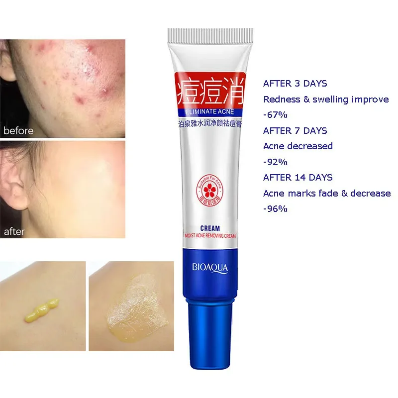 

30g Facial Cream Face Acne Creams Mark Repair Firming Moisturizing Blackhead Remover Acne Treatment skincare